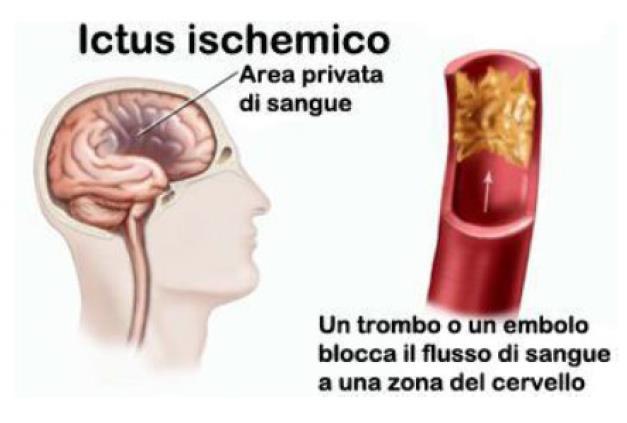 Eziopatogenesi e trattamento di prevenzione delle recidive Aterotrombosi 60-65%