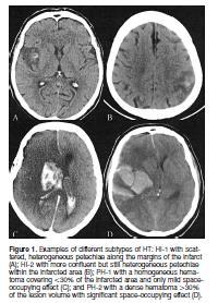 Rientro in Stroke Unit di I livello e trasferimento in reparto di Medicina di competenza territoriale La paziente è stata trasferita in III giornata in Neurologia del San Donato e in VI giornata in