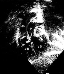 TGA+DIV: Valutazione ECO Ecocardiogramma