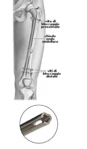 La graffetta è più larga da un lato e più stretta dall altro perché segue il decorso della tibia.