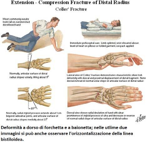 durata inferiore. L osteosintesi è inoltre più economica ma il rischio del secondo intervento fa sì che in pratica convenga direttamente mettere la protesi.