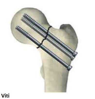 La protesizzazione d anca ha il suo sviluppo negli anni 60 80, può essere: o Endoprotesizzazzione: con la sola componente femorale, le prime utilizzate furono quelle di Moore e Thompson; oggi si
