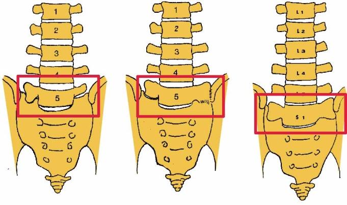 questi soggetti sviluppano in maniera anomala un abbozzo o addirittura una costa vera e propria nella porzione superiore e quindi in corrispondenza della settima vertebra cervicale.