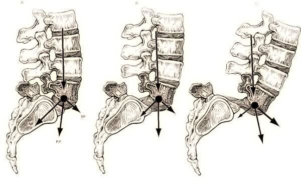 Clinica - Sensazione dello scalino (se andiamo a palpare le apofisi spinose delle vertebre troviamo che a livello della vertebra scivolata sarà molto più infossata rispetto al normale quindi