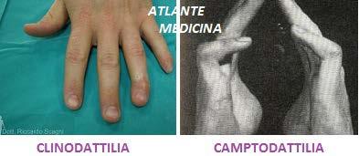 Se questo valgismo è di 10-20 gradi, parliamo di valgismo di retropiede, -Ectrodattilia (mancanza di una o più dita); -Sindattilia (fusione di due o più dita che può essere di tipo osseo o cutaneo