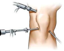 interna si determina una compressione del compartimento esterno del ginocchio quindi la manovra risulterà dolorosa nel caso di compromissione del menisco esterno.