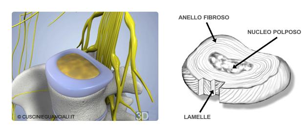 LOMBOSCIATALGIA È una sindrome dolorosa del tratto lombare con tendenza a irradiarsi all arto inferiore, con interessamento del nervo sciatico.