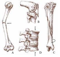 FRATTURE Si definisce frattura l interruzione della continuità anatomica di un segmento scheletrico, perlopiù in conseguenza di traumi unici, multipli o recidivanti.