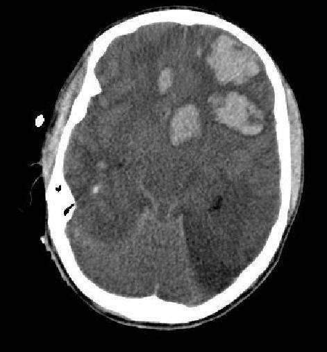 Peggiorato l edema cerebrale, l ernia uncale e la discesa delle tonsille