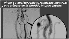 - Angiografia -
