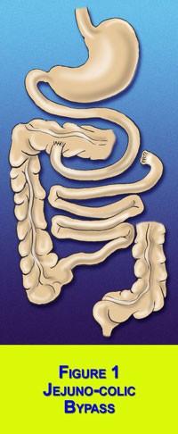 I primi interventi bariatrici 1963 Payne, DeWind Nello shunt digiuno-colico, l'intestino tenue superiore è stato congiunto ulteriormente lungo l'apparato intestinale, fino al colon, con l'idea di