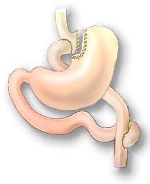 Bypass gastrico - La regola aurea 1967 Mason, Ito, et al.