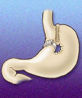 Terapia chirurgica dell obesità patologica GASTROPLASTICA VERTICALE SEC. MASON Vantaggi: Tecnicamente semplice. Calo ponderale buono a distanza di tempo.