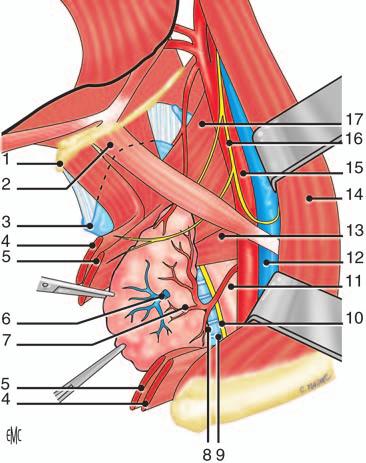 locus minoris resistentiae funzionale (diverticolo di Zenker);. fascio cricofaringeo del muscolo costrittore inferiore del faringe; 0. locus minoris resistentiae anatomico;. esofago;.