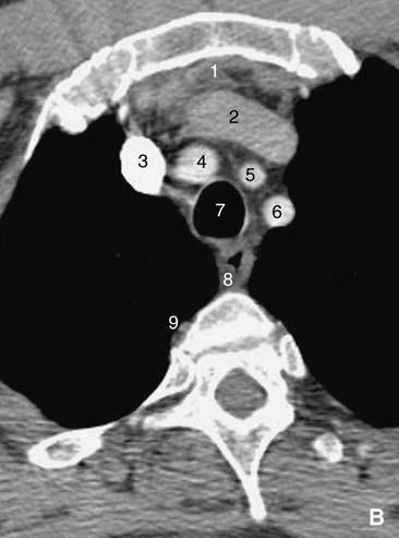 Anatomia chirurgica dell esofago I 0-0 0 Figura. Sezione orizzontale del torace a livello di TH. A. Sezione anatomica. B. Sezione tomografica.. Reliquato del timo;. vena brachiocefalica sinistra;.