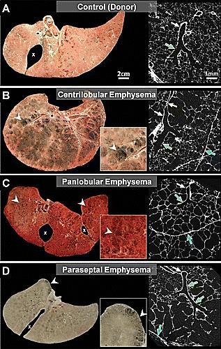 Emphysema (>6% of pixels <-950HU by QCT and/or visual identification of emphysema) Mild Centrilobular Moderate