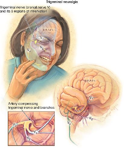 Sintomi Dolore nevralgico, acutissimo e di breve durata Scosse evocate da stimoli cutanei Distribuzione