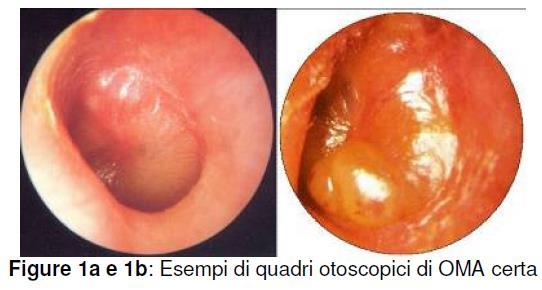 LLGG: patogeni coinvolti nell OMA I patogeni più frequentemente responsabili di OMA sono gli stessi delle rinosinusiti acute: S. pneumoniae H. influenzae M.