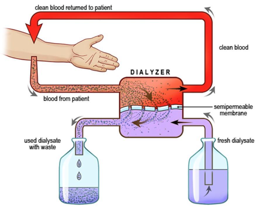 IHD Intermittent HemoDialysis Necessita di un EMODIALIZZATORE dove sangue e soluzione di dialisi