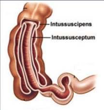1.3 Piccolo intestino INTUSSUSCEZIONE PICCOLO INTESTINO: Invaginazione intestinale in cui un tratto intestinale scivola all interno di un tratto intestinale più distale