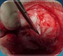 Onfalite, Onfalo flebite, Ascesso dell uraco, Cistoplastica Approccio chirurgico: Dissezione del sottocute fino alla guaina esterna del muscolo retto