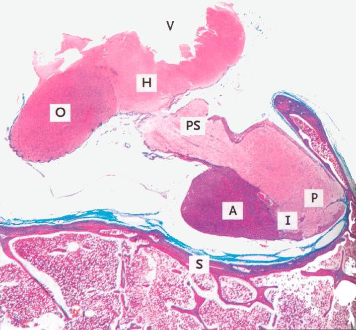 V: 3 ventricolo H: ipotalamo O: chiasma ottico PS: peduncolo ipofisario A: adenoipofisi I: pars intermedia P: