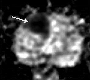 La stabilità del quadro RM riduce la necessità di biopsie ripetute Una