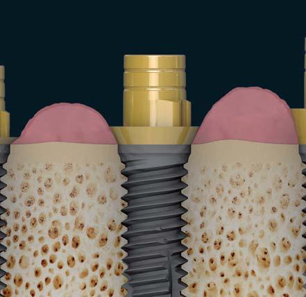 Le forze trasversali dovute ai movimenti masticatori provocano infatti forti sollecitazioni sulla struttura in