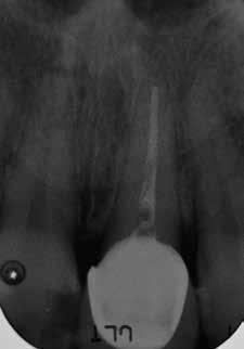 mm (Fig. 7). La radiografia endorale mostra una pregressa terapia canalare incongrua (Fig. 8).