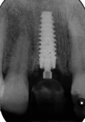 et al. La perdita di osso vestibolare in seguito all inserimento di impianti immediati postestrattivi può essere ridotta tramite la tecnica chirurgica flapless.