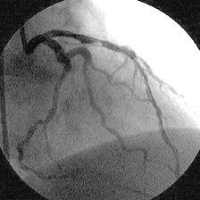 Coronary Disease à