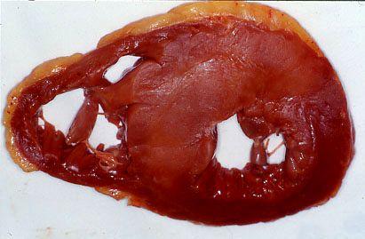 Remodelling HCM Myocardial