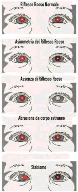 ottiche è in grado di determinare un'alterazione del riflesso rosso.