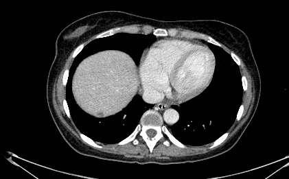 LA RECIDIVA Febbraio 2015: Episodio di subocclusione intestinale- posizionamento sondino naso gastrico.