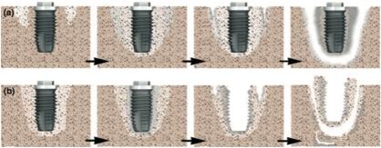 J Oral Maxillofac Surg. 2013 Aug;71(8):1360-6. Kwon TG, Lee CO, Park JW, Choi SY, Rijal G, Shin HI.