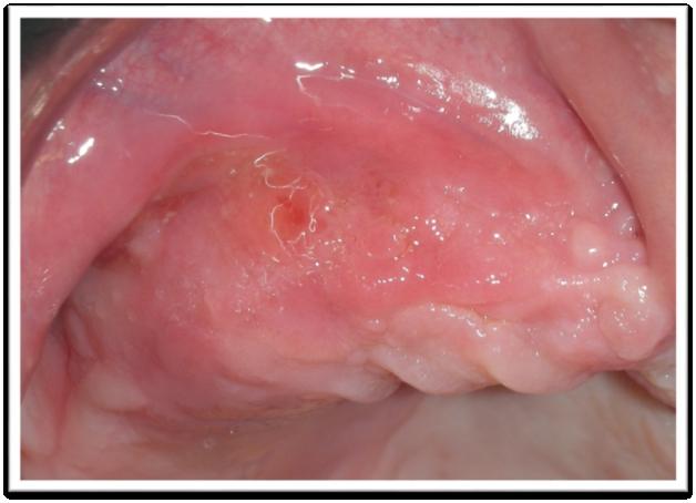 #3 Presenza di fistola mucosa in sede 1.4 in assenza di esposizione di osso necrotico.