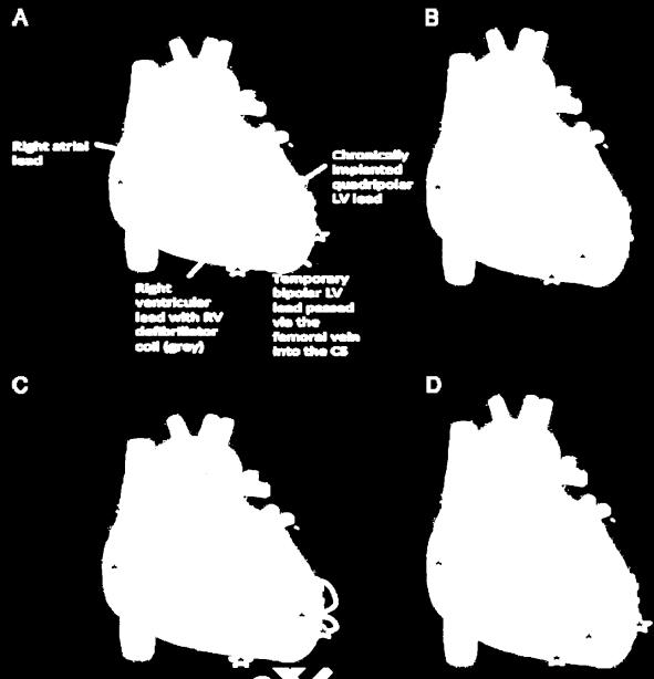 CRTsystem (BIV implanted) - BIV pacing delivered via analternative temporary LV lead (BIV altern) - MultiPoint Pacing delivered via 2