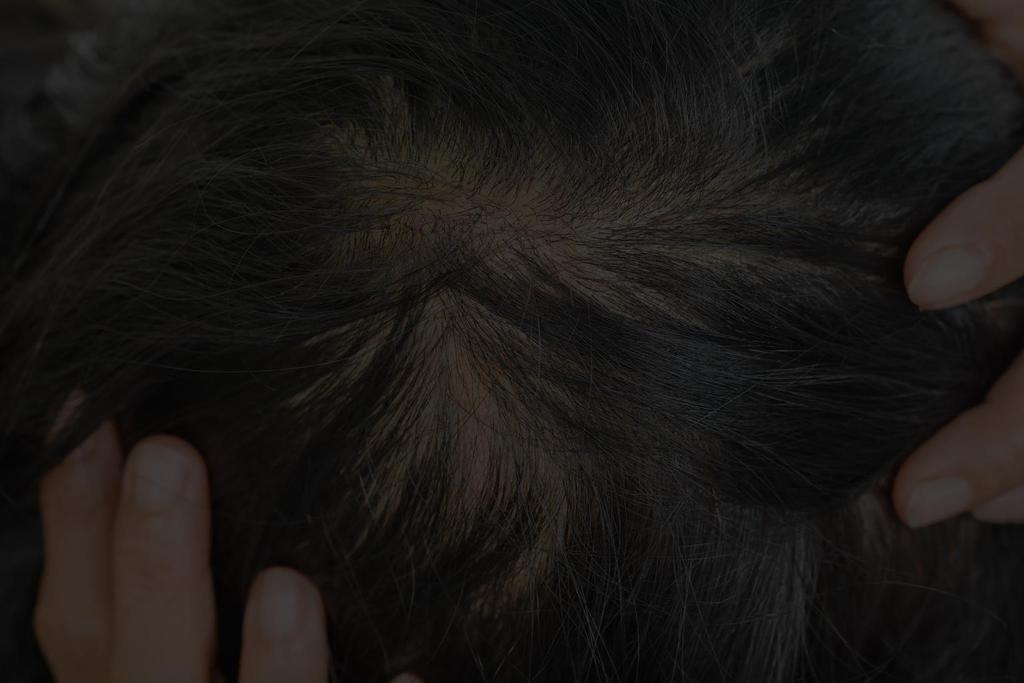 La clinica del Deficit delle Gonadotropine Nelle donne oligo-amenorrea, diradamento dei capelli, perdita dei peli pubici