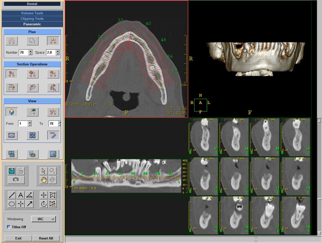 TC dentaria La TC, grazie all applicazione di software di ricostruzione dedicati per fini implantologici, è divenuta una tecnica di valenza strategica per poter formulare giudizi diagnostici sempre