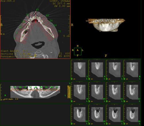 Osteonecrosi da