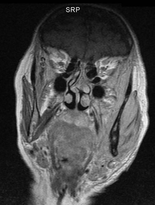 Osteonecrosi/osteomielite del corpo