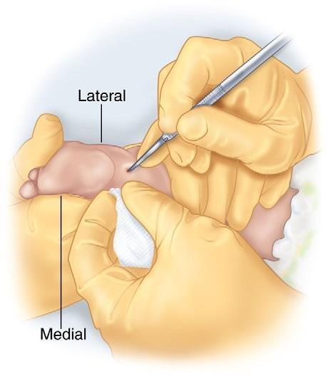 il piede, bisogna applicare il tutore (solitamente indossato dopo l ultima tappa correttiva in gesso successiva alla tenotomia) per