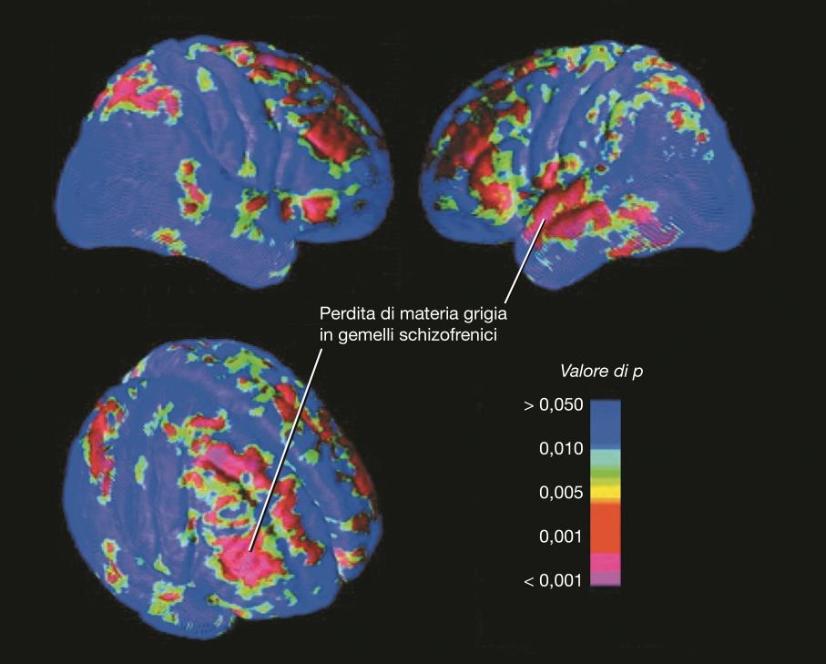 Schizofrenia Nei gemelli monozigoti e dizigoti discordanti per la schizofrenia sono stati registrati deficit simili nella corteccia prefrontale dorsolaterale e nel giro temporale superiore.