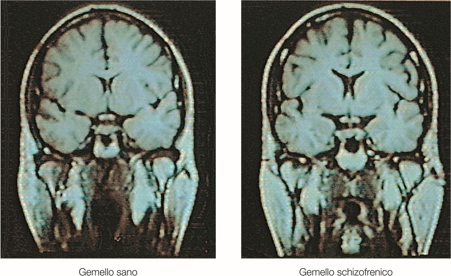 Schizofrenia Assottigliamento della corteccia prefrontale dorsolaterale, regione più critica per la memoria operativa Assottigliamento del lobo temporale (giro temporale superiore, polo temporale,