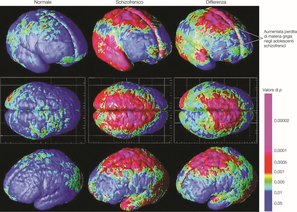 quella dei soggetti di controllo Coinvolgimento sia della corteccia prefrontale che del sistema dopaminergico nella sua patogenesi