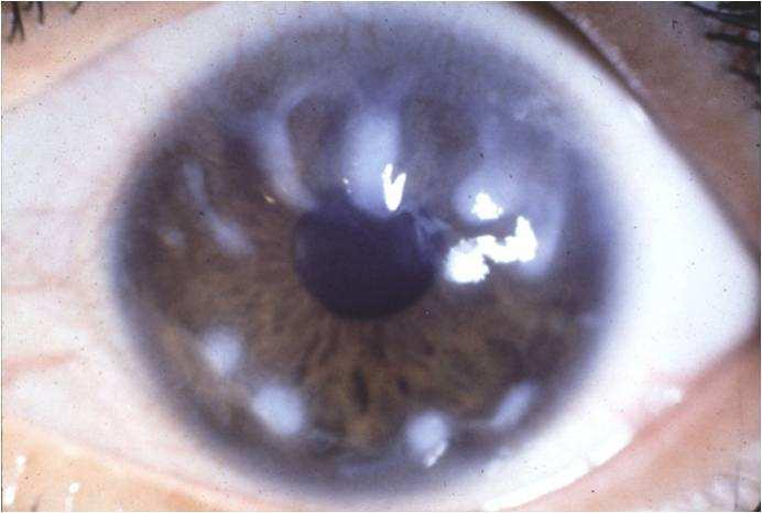 Modificazioni della membrana di Descemet Corpi di Hassall-Henle : Piccole escrescenze ialine biancastre sulla superfice anteriore della membrana di Descemet localizzate alla periferia della cornea;