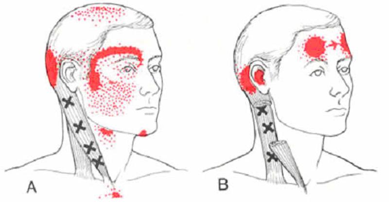 Sintomatologia -Cefalea occipitale e/o retro-orbitaria -Talora cefalea frontale-temporoparietale