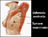 Le indicazioni alla biopsia del linfonodo sentinella sono: Carcinoma mammario T1-T2 di diametro inferiore o uguale a 3 centimetri con linfonodi ascellari non sospetti.