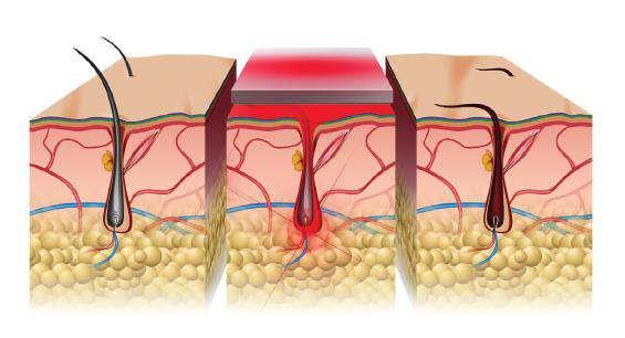 Come funziona il Laser? Il bersaglio della luce del laser è la melanina, una proteina che viene utilizzata dall organismo come pigmento e colora di scuro la pelle e gli annessi cutanei come i peli.