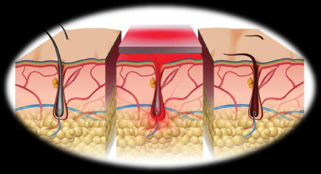 MECCANISMO DI PENETRAZIONE DEL LASER Pelo in fase attiva prima di essere trattato